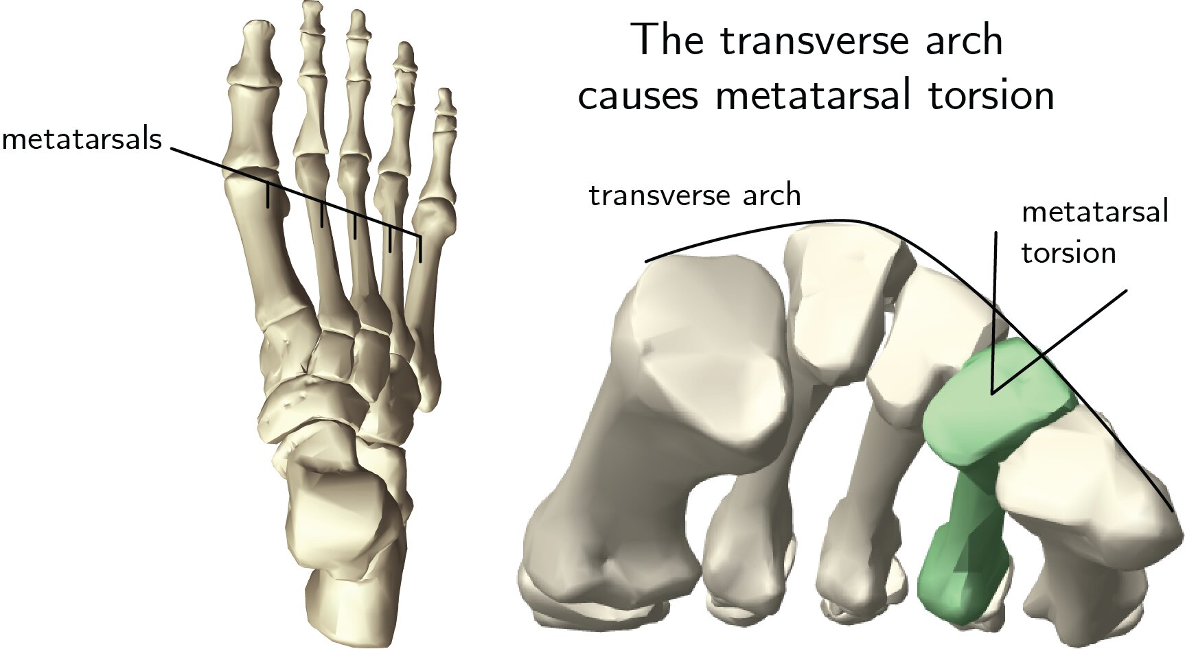 大拇脚趾短粗怎么改善,拇外翻手术大脚趾变短怎么办