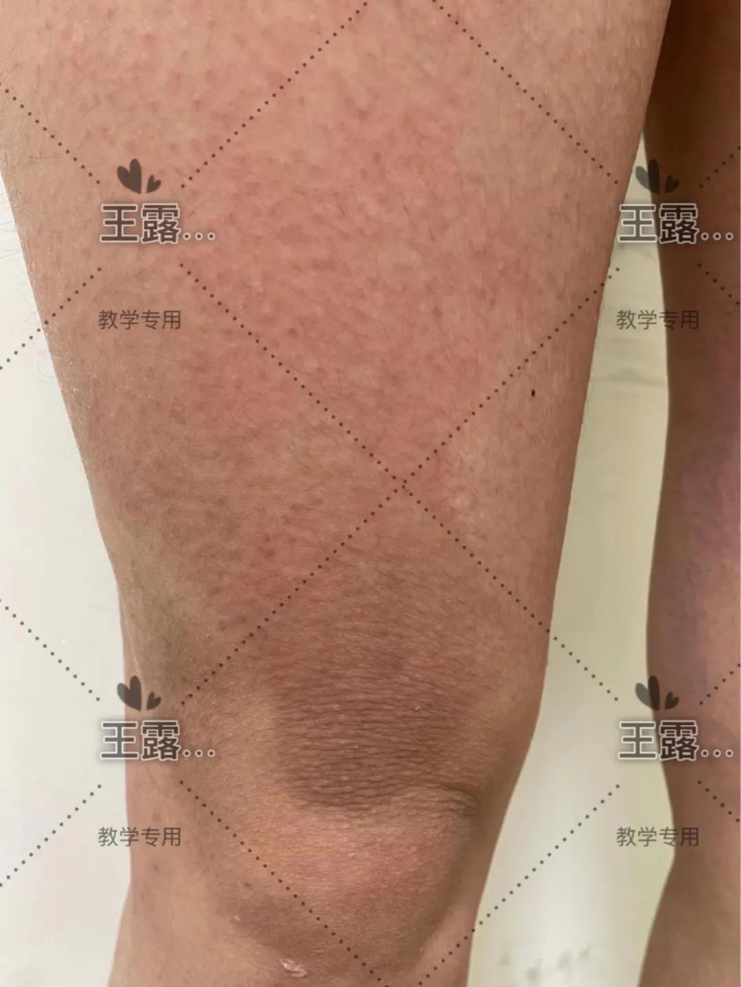 怀孕腋窝腹股沟腘窝起成片的疹子,妊娠皮疹是怀的多是男孩