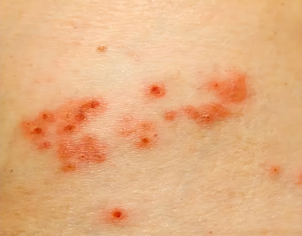 各种性疾病的传播途径,通过性传播的八种疾病