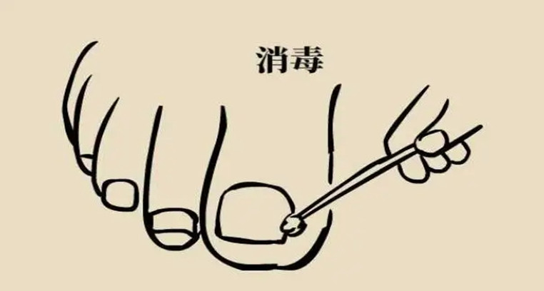 脚趾甲老往肉里钻，一碰还疼？教你小妙招，预防甲沟炎告别疼痛