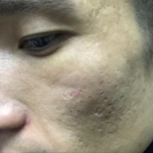28岁小伙三次治疗痘坑，终于摆脱自卑，变得自信阳光