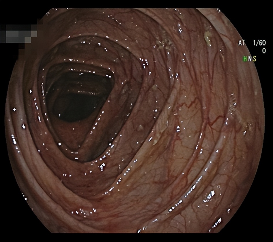 20多岁年轻姑娘，她的肠道竟然是这样的……