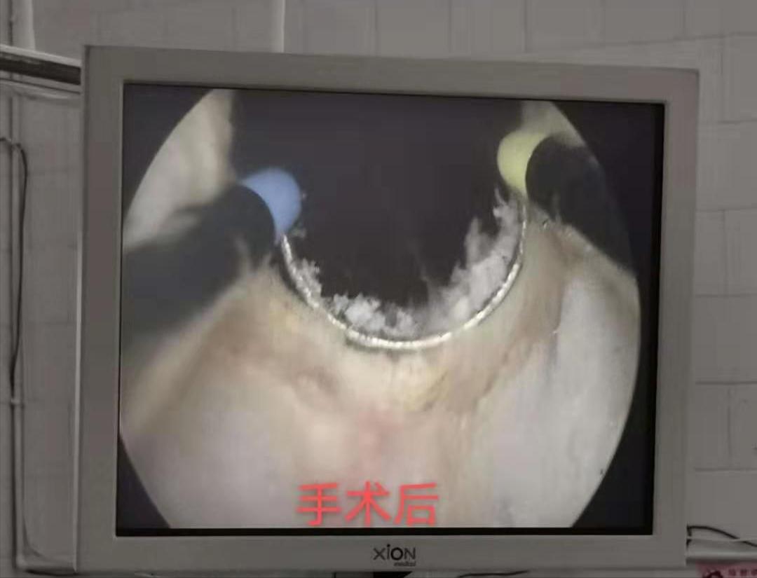 经尿道前列腺等离子切除术,TUPKRP