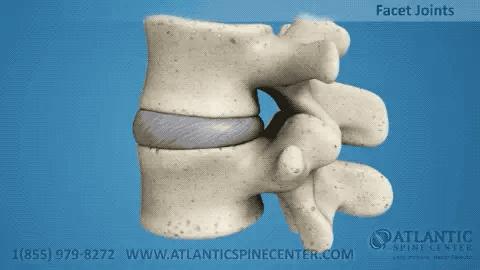 腰椎间盘突出345s1可以微创吗,腰椎间盘突出微创手术后康复动作