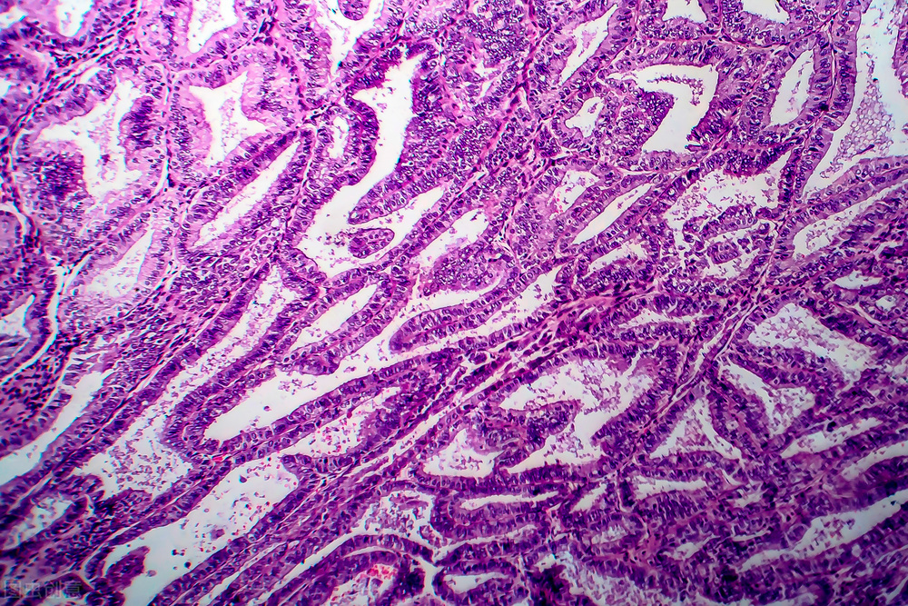 不均质低回声边界清内有血流信号,边界欠清回声不均匀一定是恶性吗
