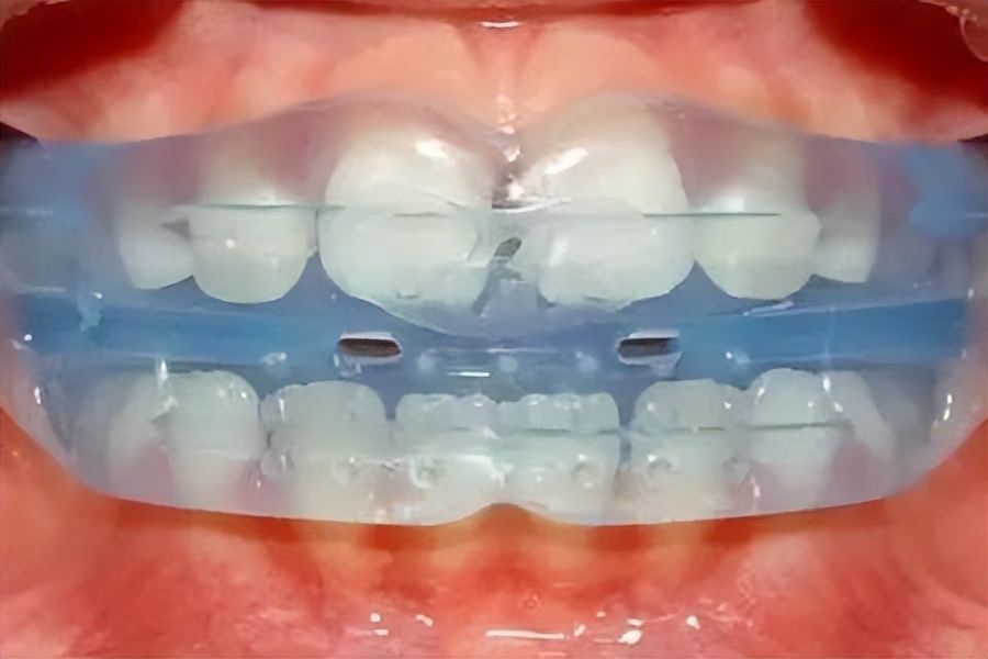 关于早期干预的案例,最新正畸技术