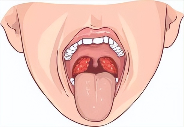扁桃体炎是不是很严重,扁桃体炎就是感冒吗