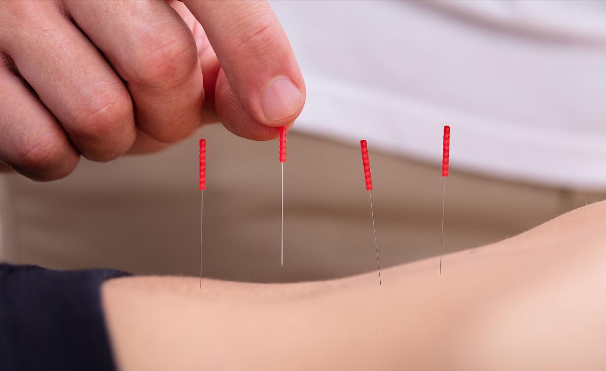 针灸临床经验选编精华,古法针灸临床治验