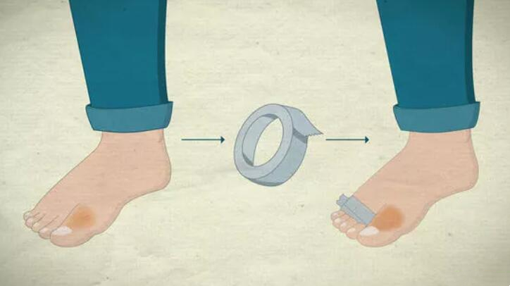 脚趾骨折断端稍分离移位,判断脚趾是骨折还是损伤的方法