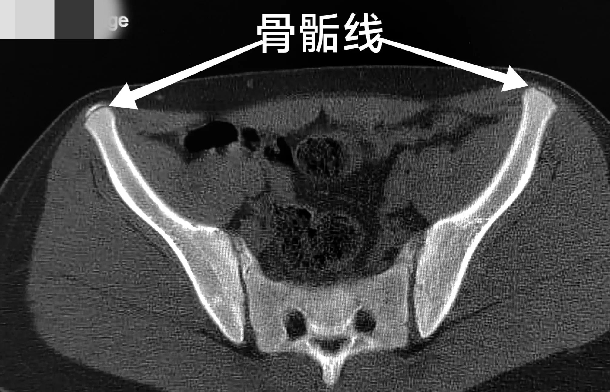 警惕｜跑完步后大腿根痛，一查竟是骨折了，青少年多见