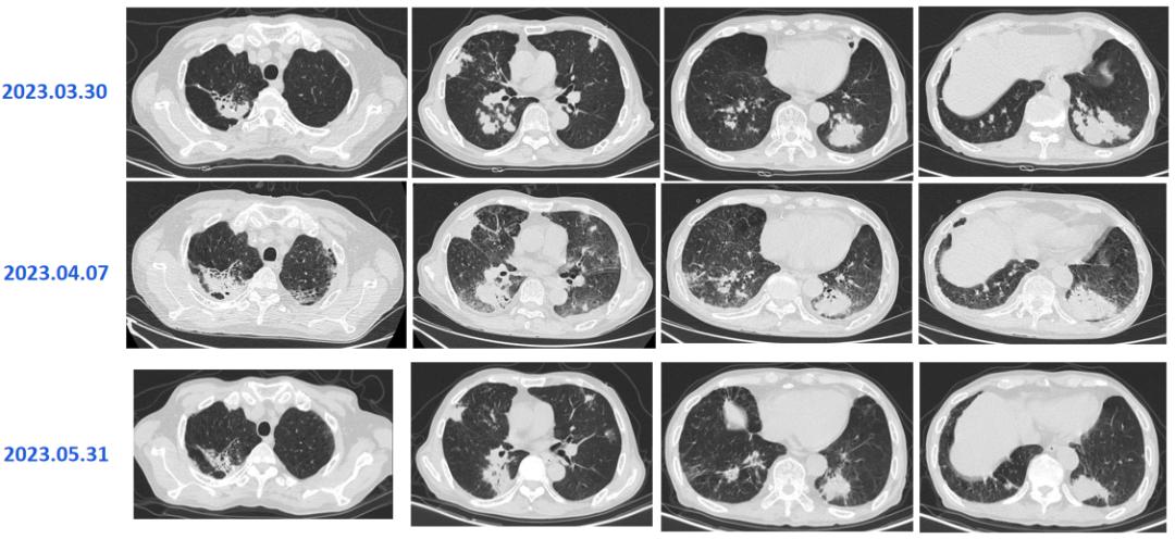 hiv感染肺孢子菌肺炎,hiv患者检查出耶氏肺孢子菌
