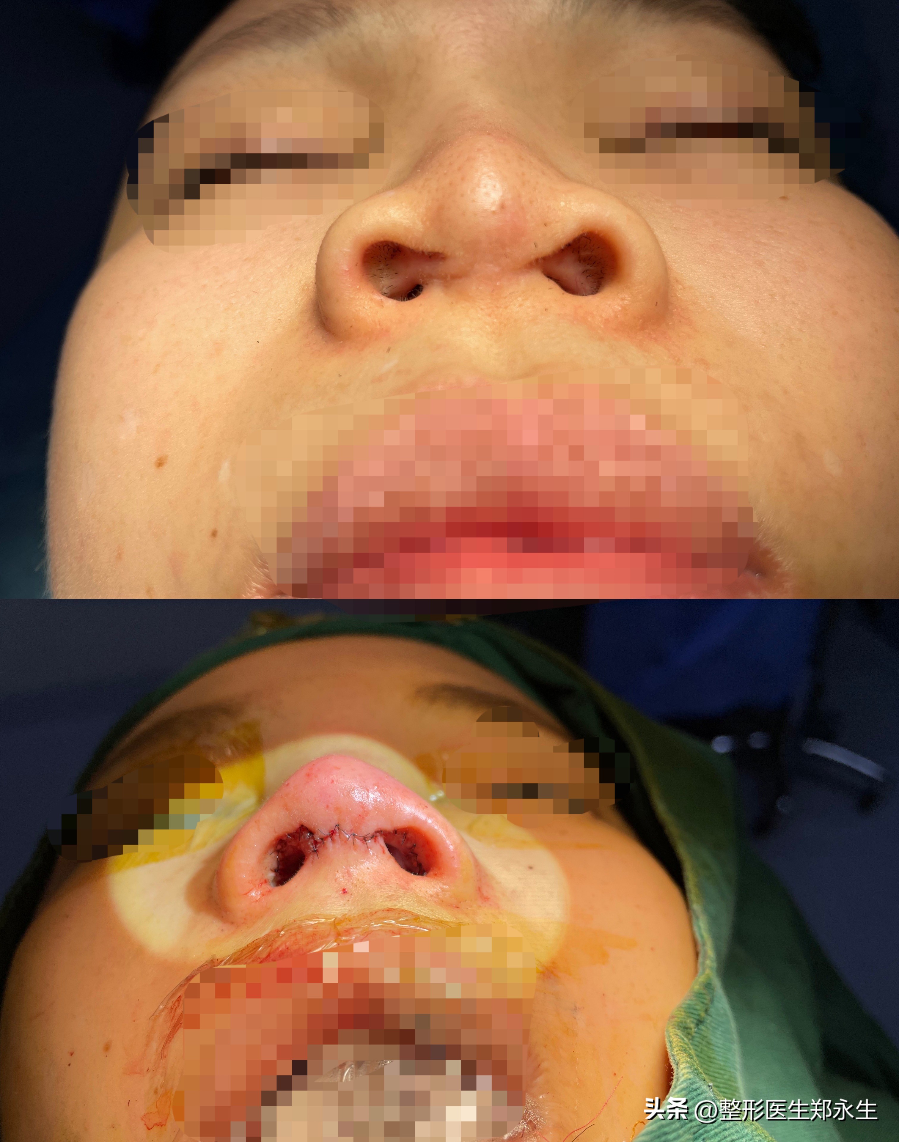 女子花7000去美容不料整成红鼻子,女子花7万整容做鼻子
