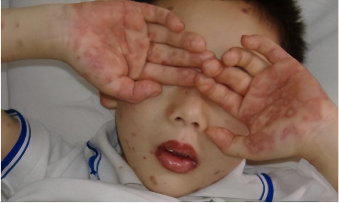 手足口病儿童的3大护理方法,手足口病六个小妙招