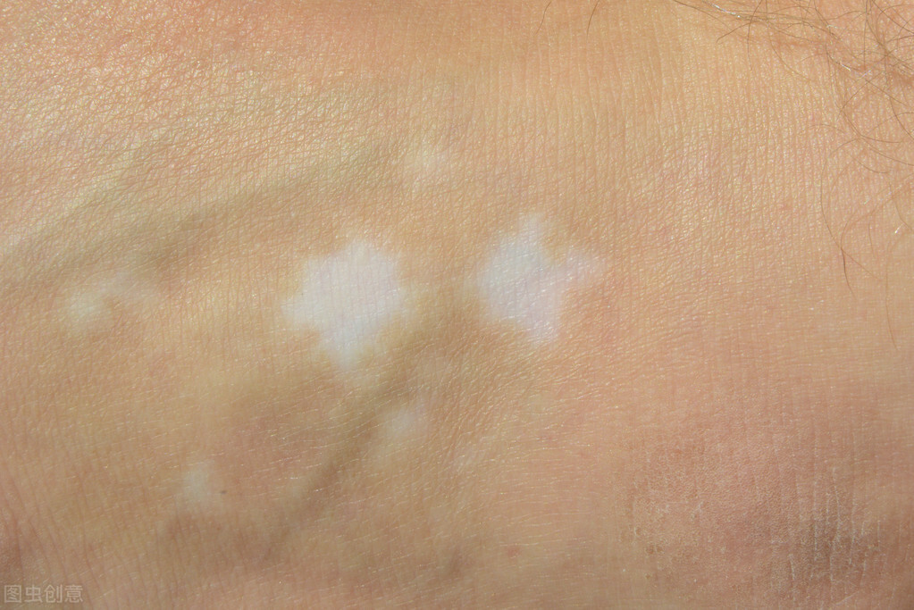 腿上得白癜风该如何治疗,白癜风一般会先出现在腿上吗