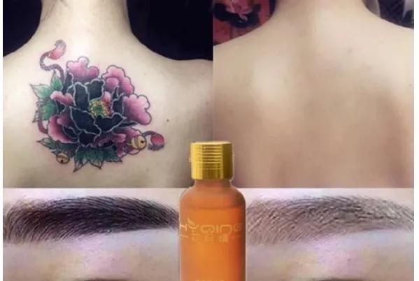 为洗纹身买单,洗纹身有什么代价