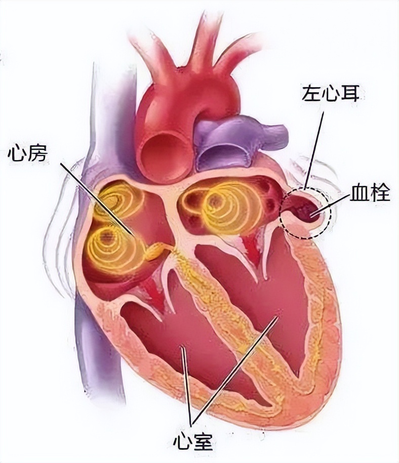 房颤最常见并发症是脑梗死吗,房颤引起的脑梗死怎么治