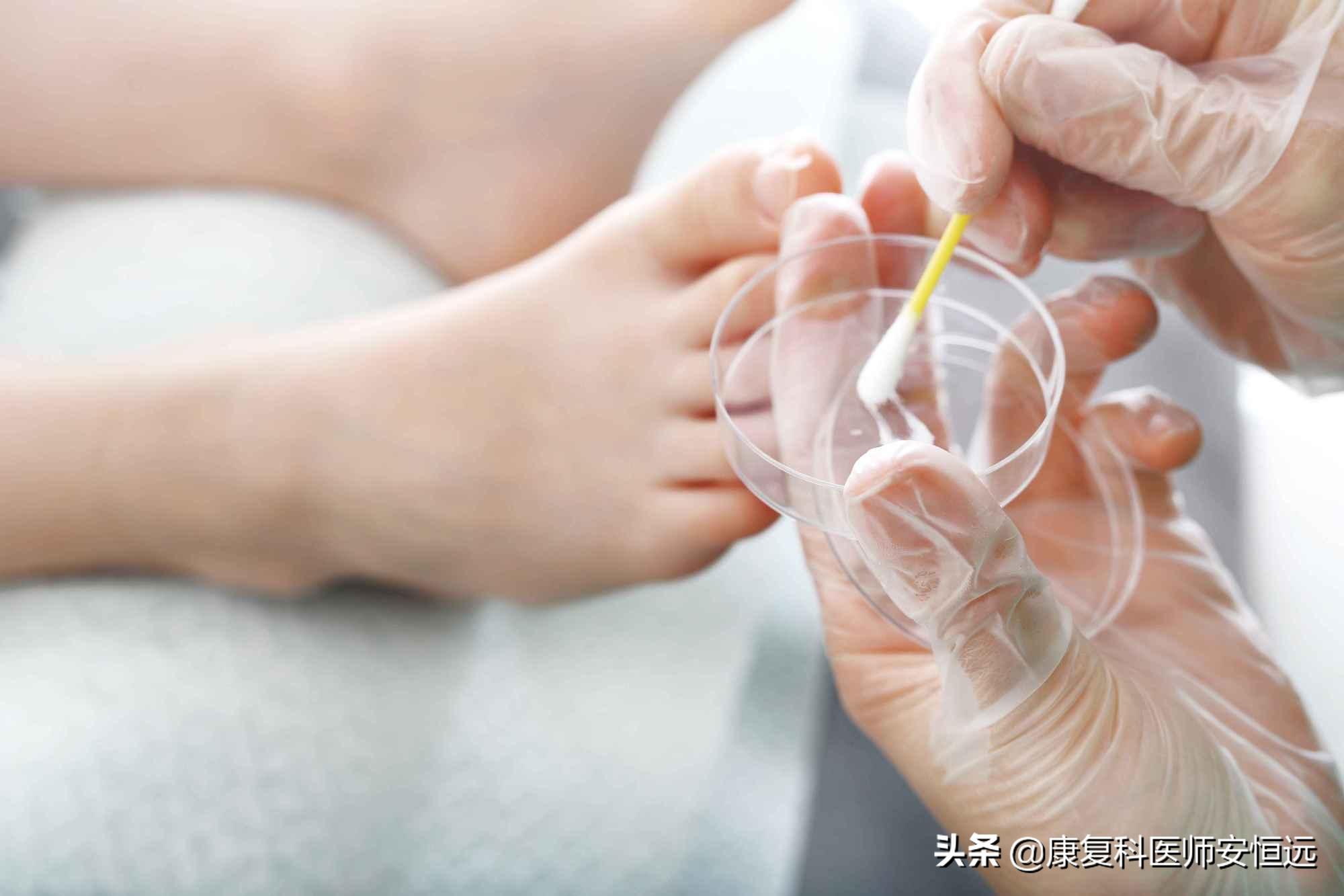 脚气反反复复总是不好是怎么回事,脚气反反复复怎么根治啊