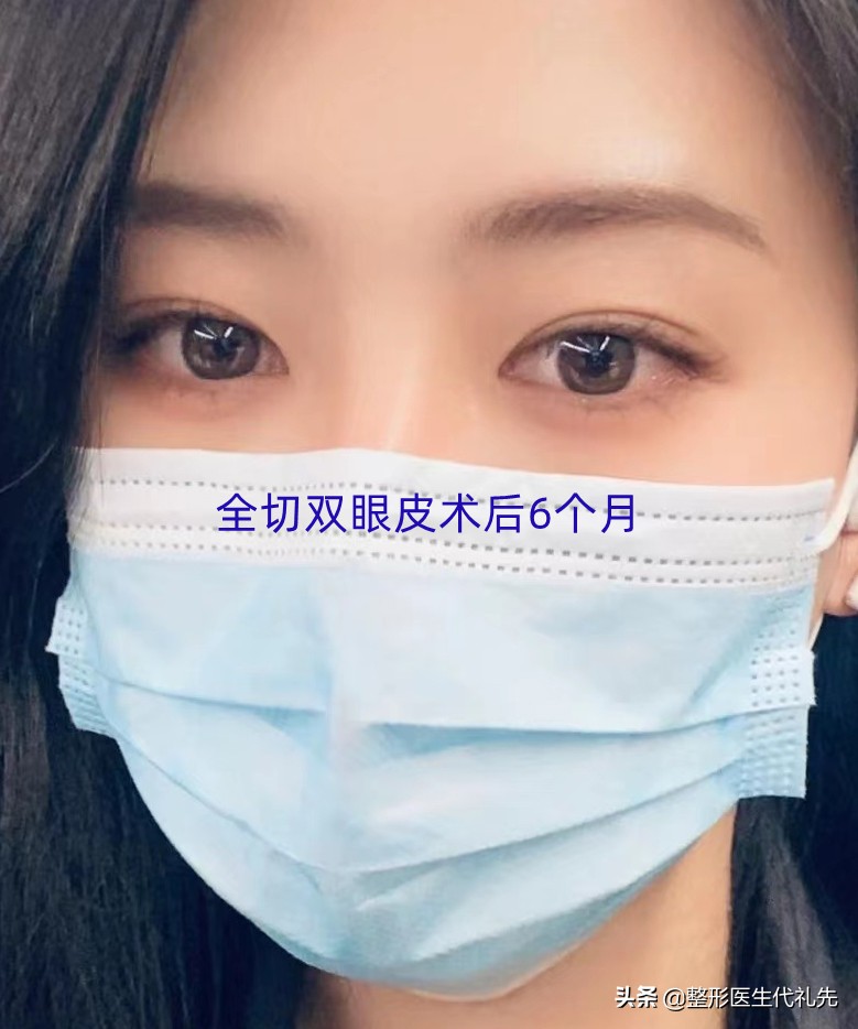 45岁全切双眼皮一月恢复过程,40岁全切双眼皮术后记录