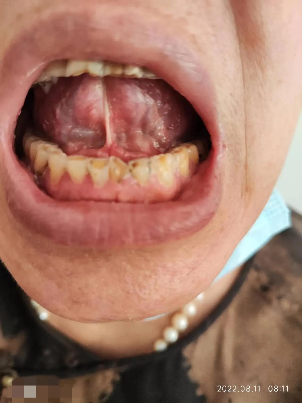 干燥综合征吃中药多久可以控制,干燥综合征喝中药可以治愈吗