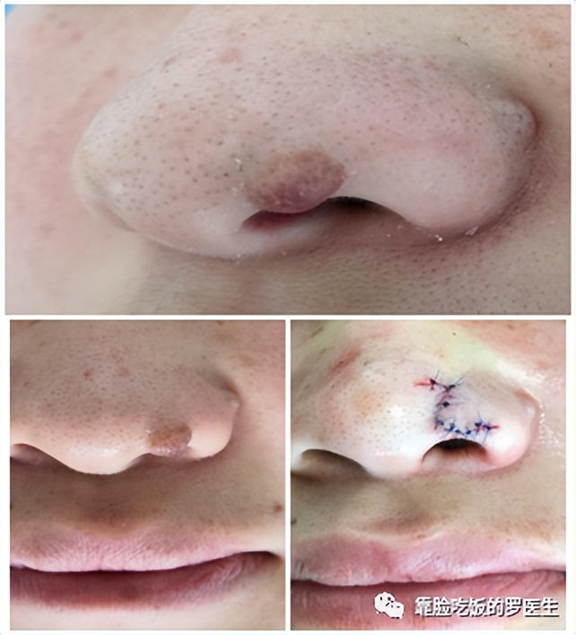 脸上的痣带毛还比较大怎么去除,脸上的痣去掉后长了个肉疙瘩