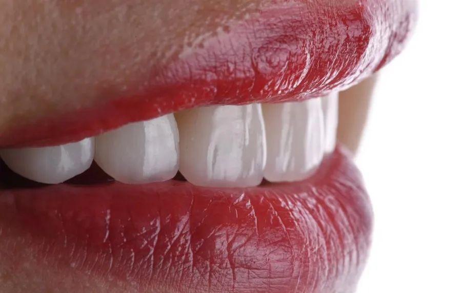 牙齿贴面的材料和品牌区别,牙贴面品牌十大排名最新