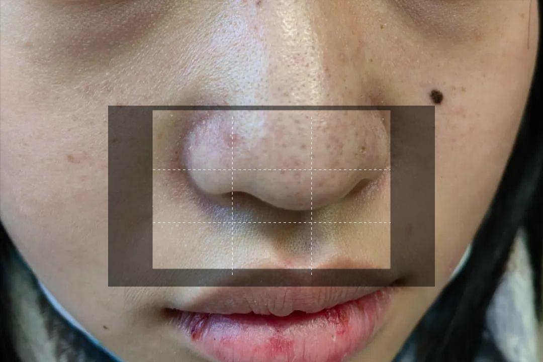 面部皮炎是炎症吗,脂溢性皮炎面部痒