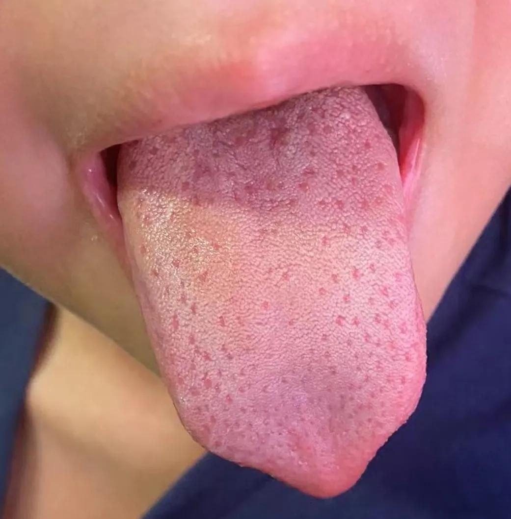 儿童发热后有红点是怎么回事,儿童发热后身上起红疹子