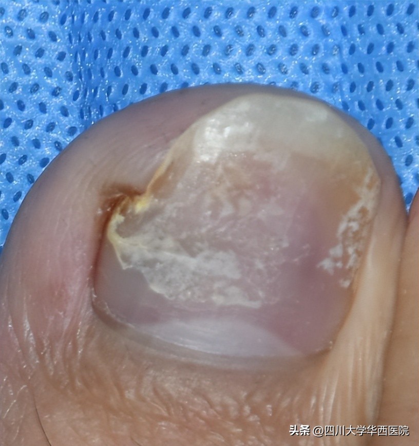 华西专家说，不是转你们，起码有一半的人从没有剪对过指甲儿！