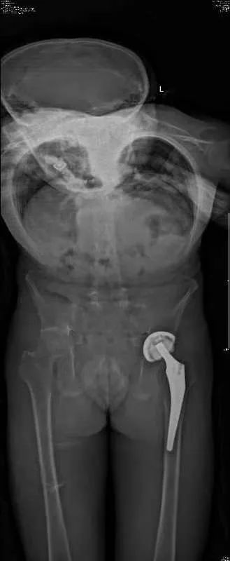 手术后平躺六小时睡着了,手术后终于睡着了