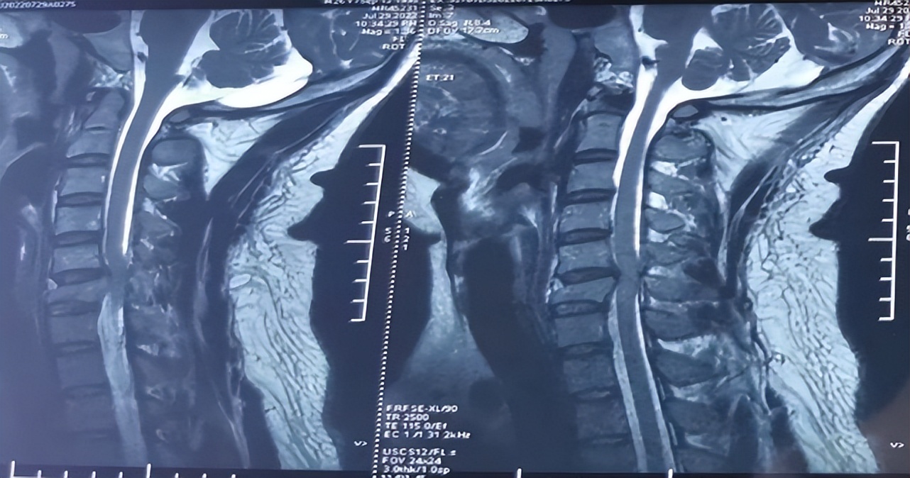 救治背部被砸伤男子,男子救人被砸中在icu抢救超24小时