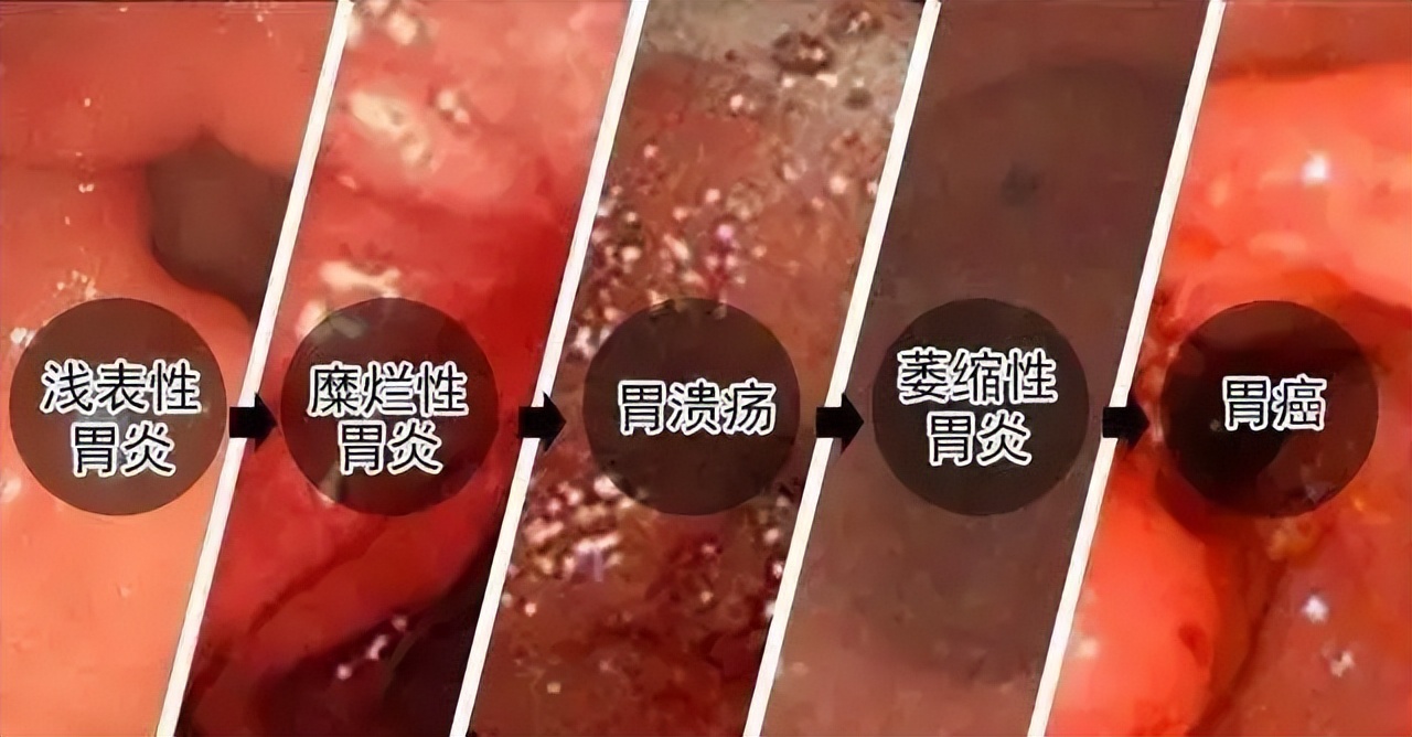 68岁老人腹胀，确诊1个月后去世，家属大哭：天堂的儿子太想妈妈