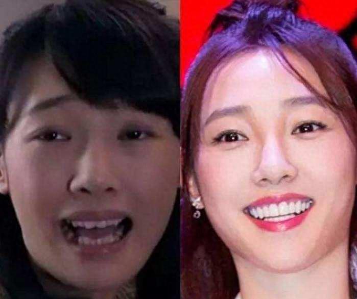 明星烤瓷牙发黑,明星烤瓷牙牙齿磨小后照片