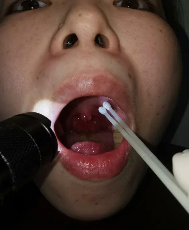 口咽、鼻咽拭子采集标准