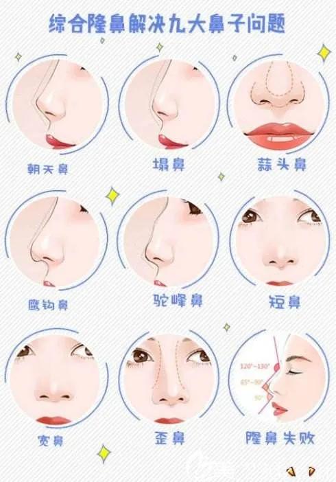 隆鼻为什么要耳软骨效果最佳,鼻综合耳软骨隆鼻视频