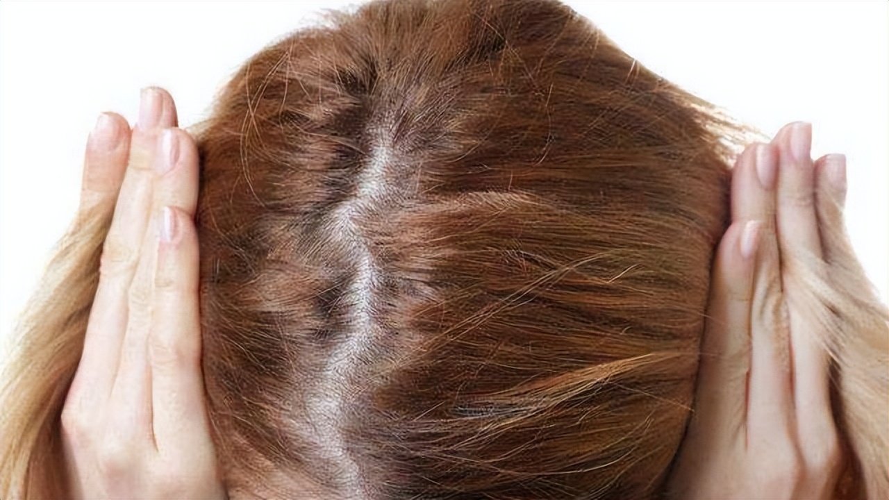 脱发为什么都是从头顶先秃,脱发为什么先从头顶脱