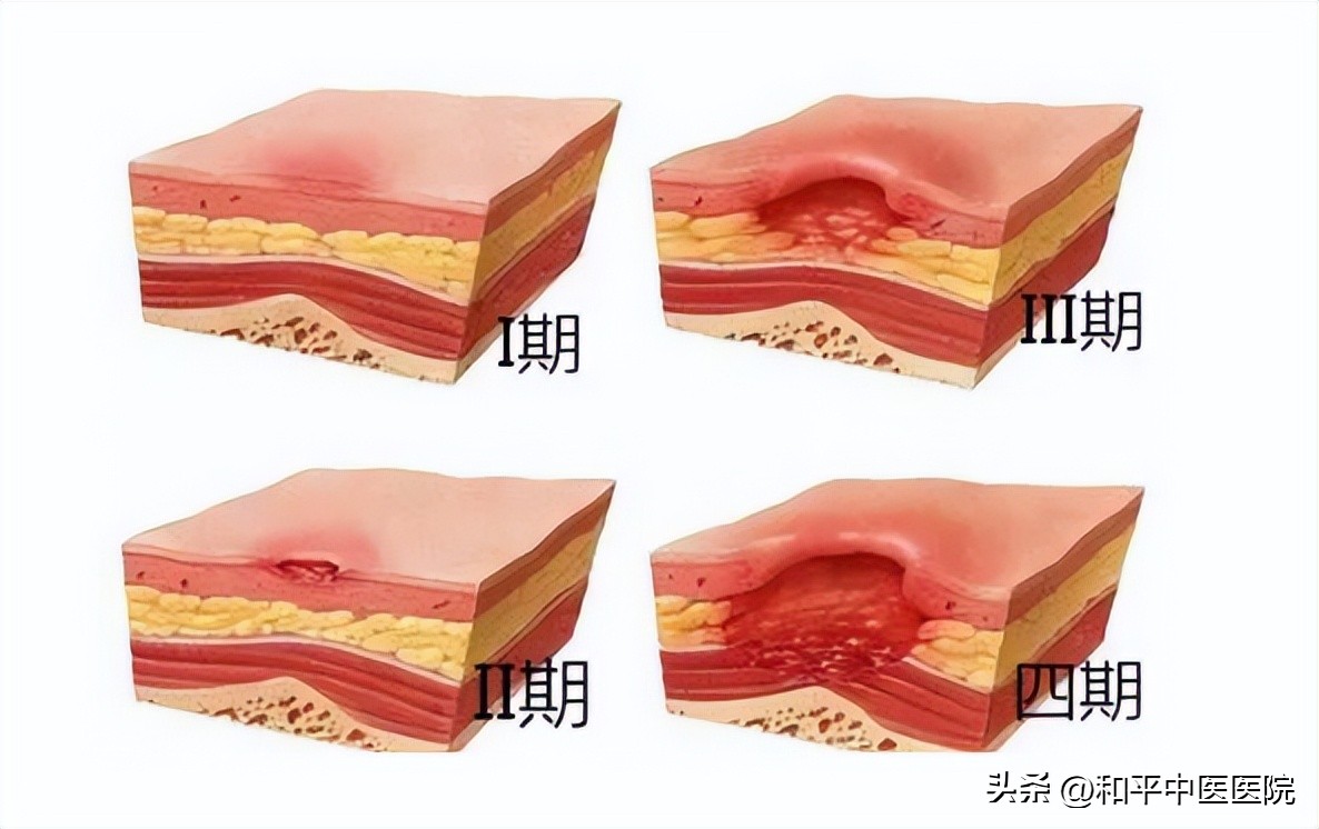 老年人压疮化脓怎么护理,卧床老人一度压疮能治好么