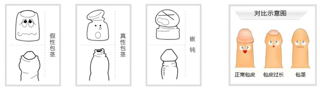 割包皮早割迟有影响吗,早割包皮对孩子的好处