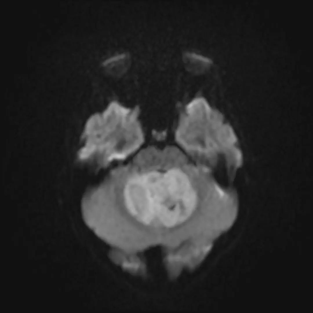 经典型髓母细胞瘤,影像诊断图片解析