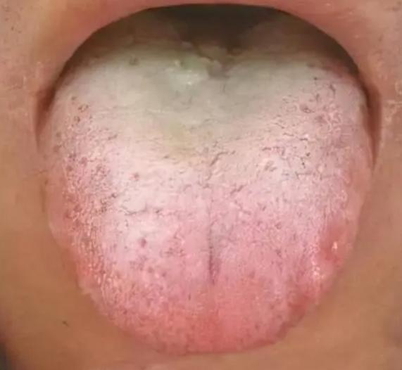 胸闷气短张仲景药方,张仲景治疗痰饮湿盛方子