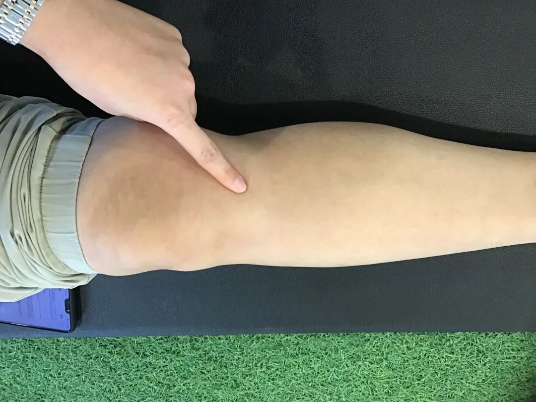 儿童股骨干粉碎性骨折对位不太好,儿童股骨干骨折石膏固定