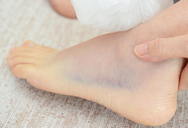 崴脚肿了一定是骨折吗,崴脚严重骨折肿出大包