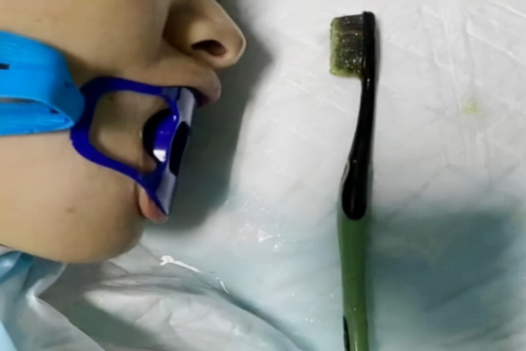 女子刷牙不小心把牙刷咽下去了,女子刷牙时牙刷滑进胃里