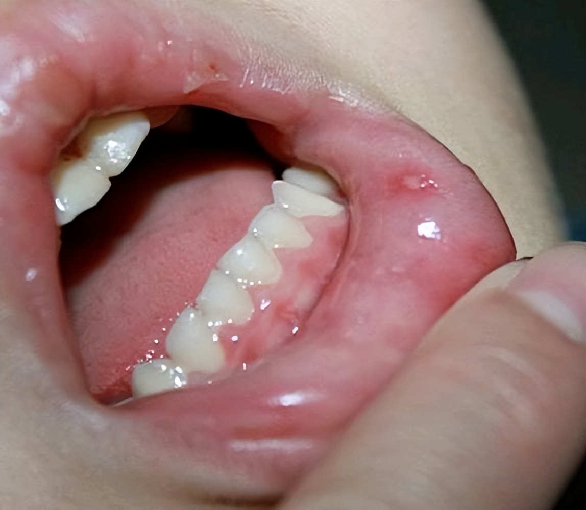 口腔溃疡含维c特别疼,口腔溃疡可以同时吃维b2和维c吗