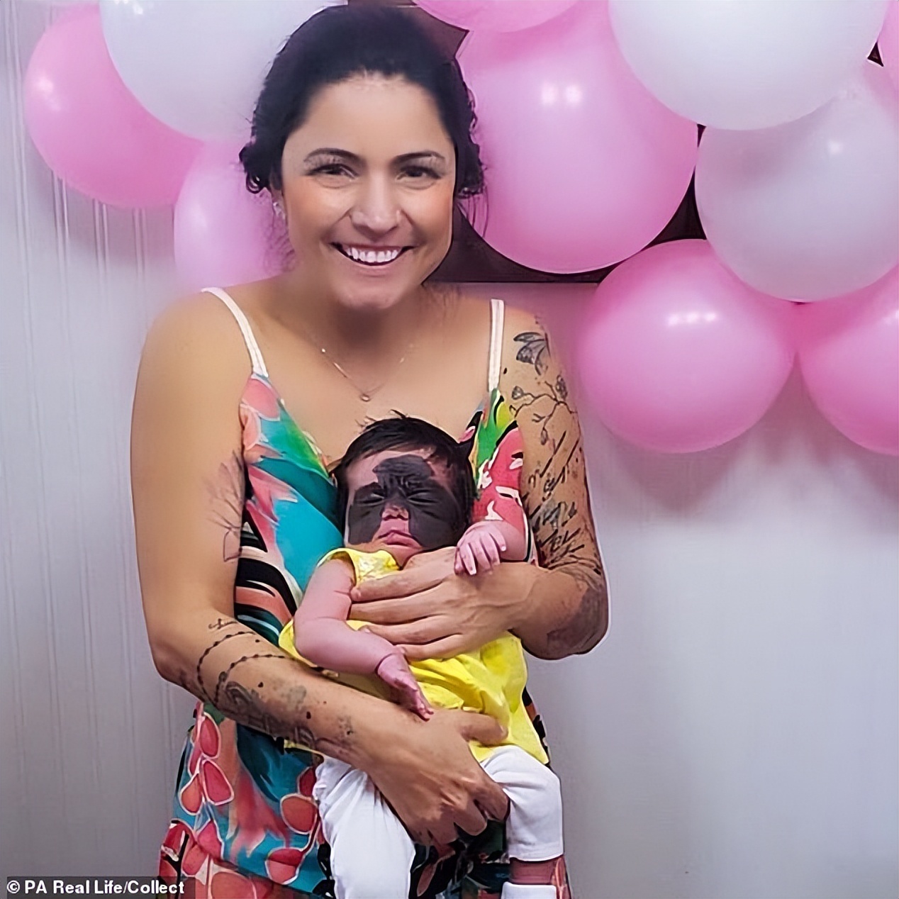 美国小女孩脸带“蝙蝠侠”黑印,治疗两年经过终于恢复肉色!