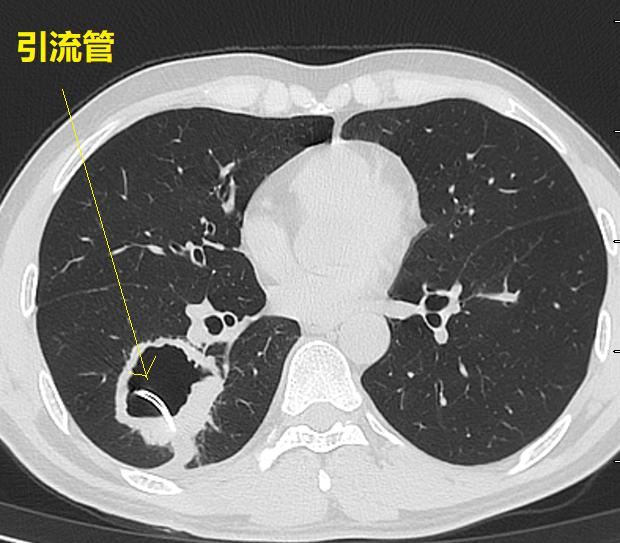 肺脓肿导管引流,肺脓肿的引流管脱落怎么办