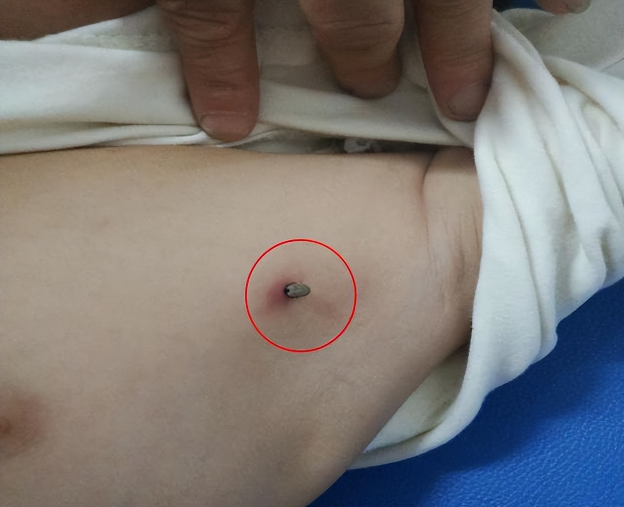 夏天碰到这种小虫子要警惕,这些常见又危险的小虫子