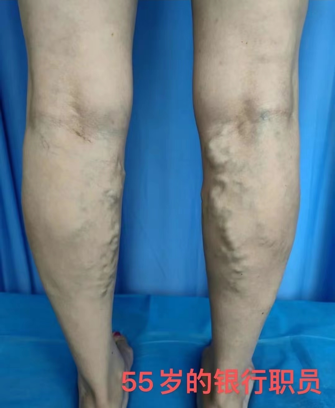 济南显微外科医院静脉曲张,杨医生静脉曲张小视频