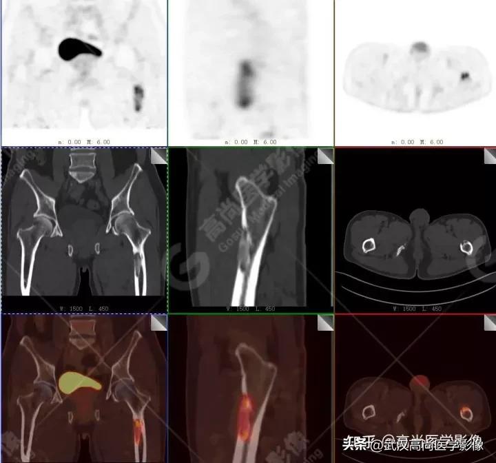 10毫米的肺结节恶性死亡率有多大,1厘米多的肺结节良性可能性多大