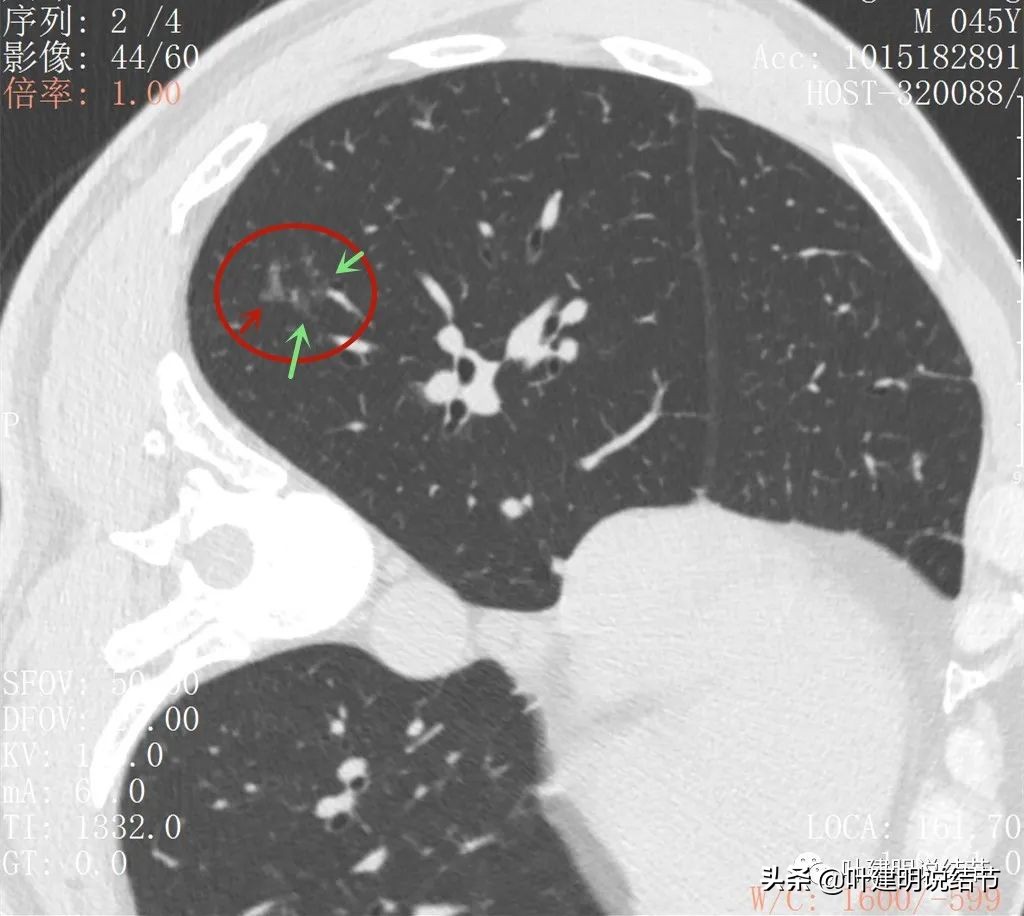 误诊肺纤维化,肺蜂窝状是癌吗