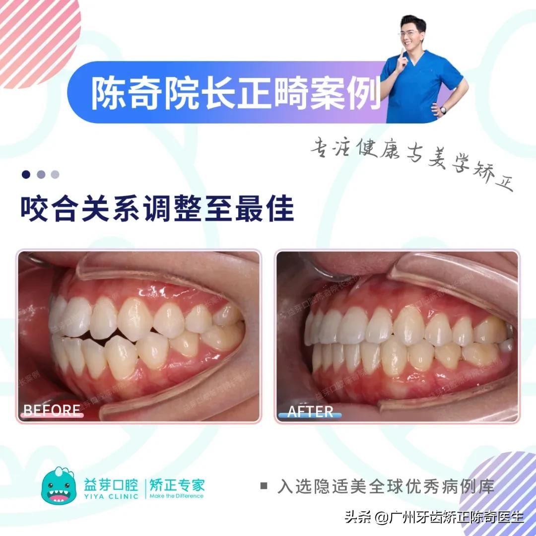 隐适美矫正和普通矫正的区别,隐适美矫正有几种版本